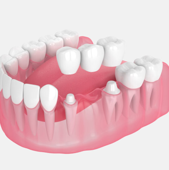 Dental Bridges