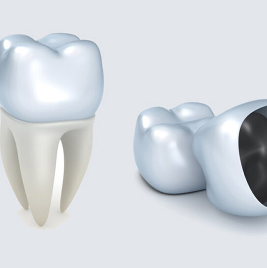 Dental Crowns