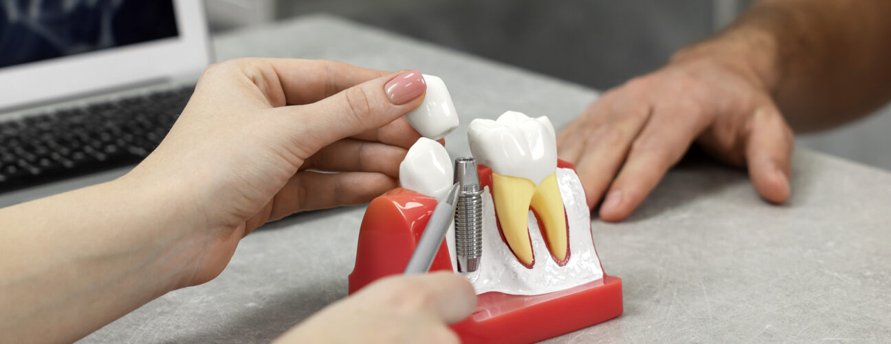 Dental Implants Restorations