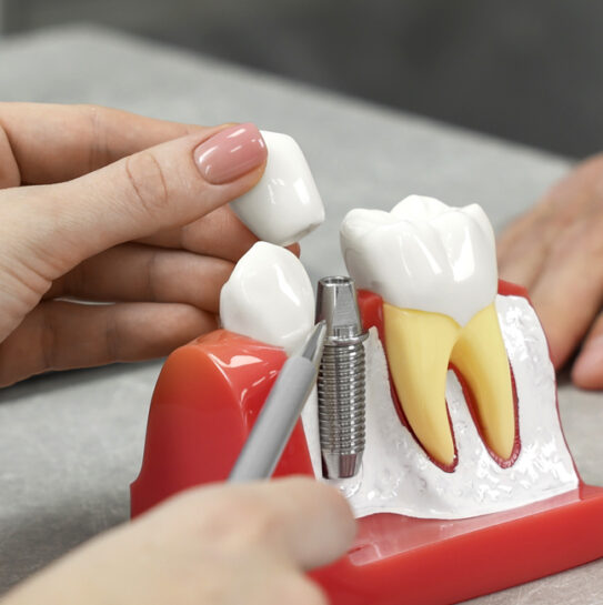 Dental Implants Restorations