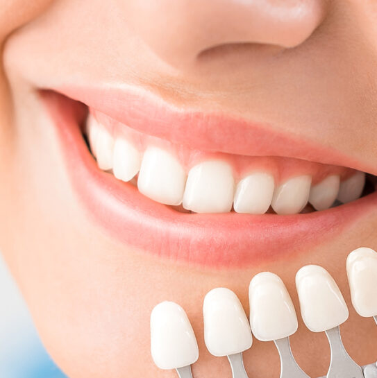 Dental Veneers