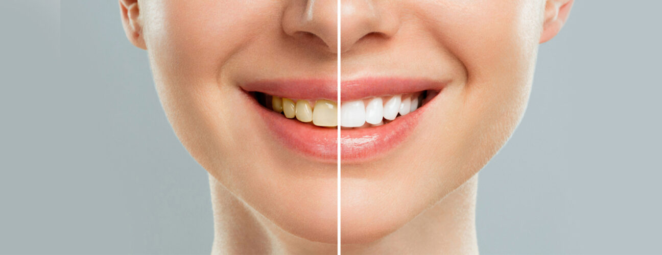 Teeth Whitening