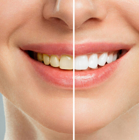 Teeth Whitening