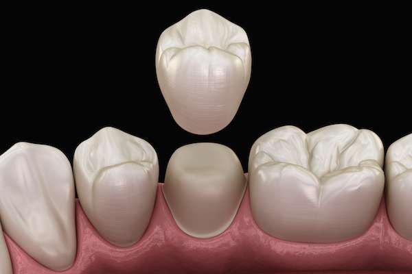 What To Ask Your General Dentist When Preparing for a Crown from Premier Esthetics Dental Office of Mark R. Gadberry D.D.S., Inc. in Covina, CA