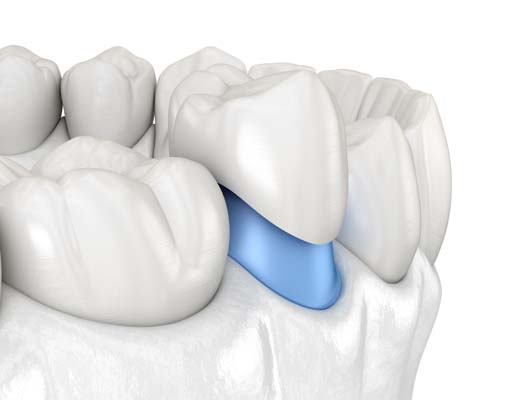 Commonly Asked Questions About CEREC Same Day Crowns