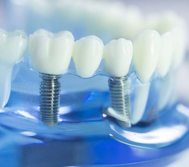 Covina Dental Implants